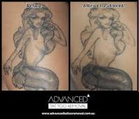 Advanced Tattoo Removal image 4